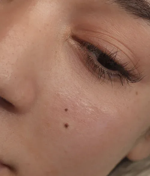 Beauty spot and soft skin freckling