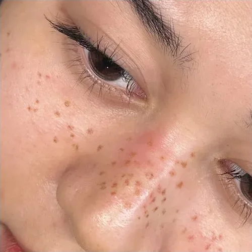 Freshly tapped nose and cheek freckles